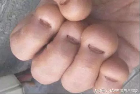 20岁少女患癌遭截肢 有人丧命 这习惯你也可能有 千万注意