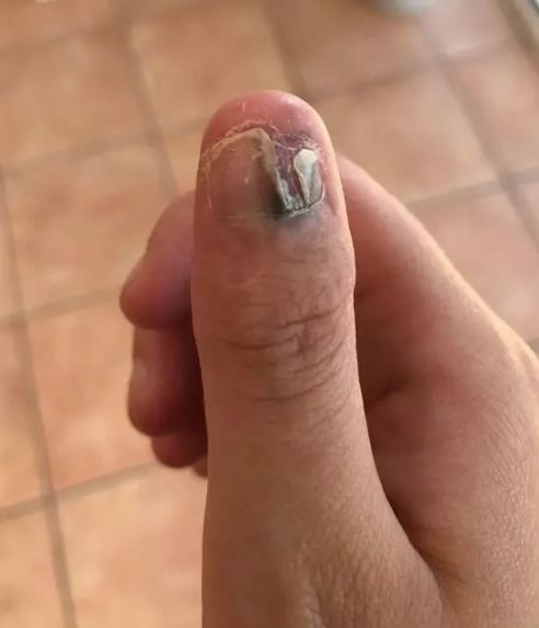 20岁少女患癌遭截肢 有人丧命 这习惯你也可能有 千万注意