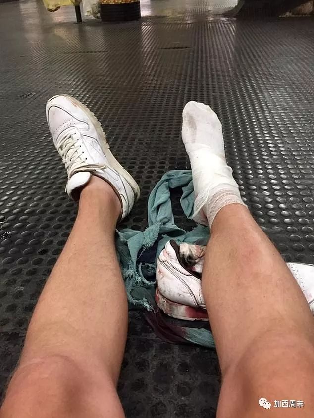 可怕！扶梯突然失控 人群卷入底部！有人惨遭截肢 温哥华男童被绞断腿