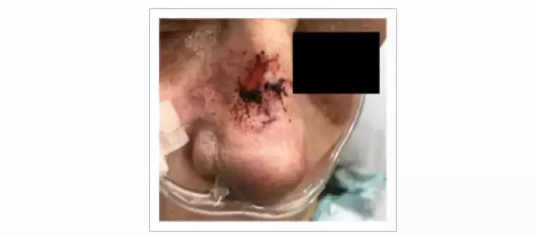 吓人！女子用自来水洗了一下鼻子 一个月后死了！