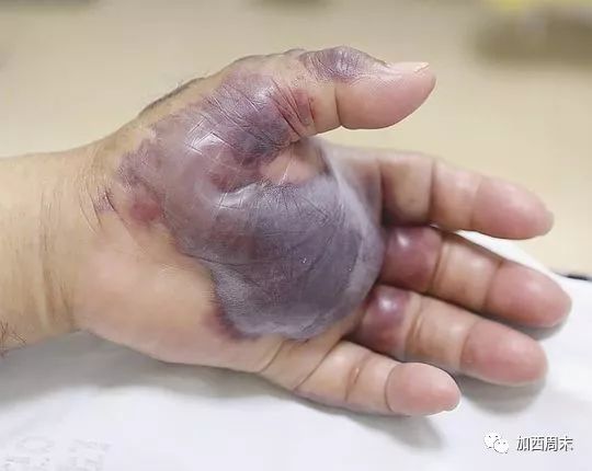 精英工程师吃了顿海鲜 全身溃烂 截掉四肢 系全家唯一经济来源 妻子已崩溃
