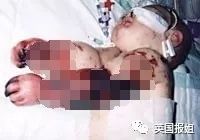 澳洲小姐姐感冒竟导致截肢？着凉发烧别硬撑！