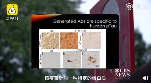 振奋人心! 老年痴呆症疫苗研制成功 5000万家庭有救了!