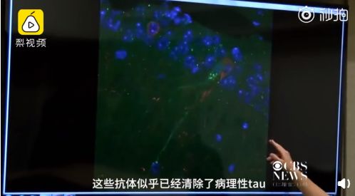 振奋人心! 老年痴呆症疫苗研制成功 5000万家庭有救了!