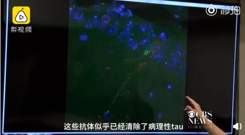 振奋人心! 老年痴呆症疫苗研制成功 5000万家庭有救了!