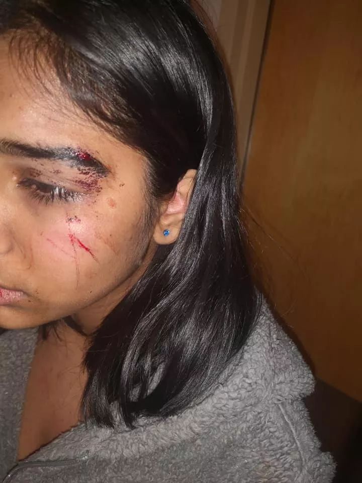 愤怒! 大温14岁亚裔女孩在学校遭男学生围殴 脸被踹到破相! 妈妈崩溃!