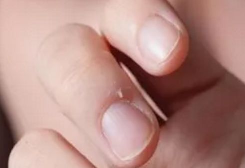 警惕! 男子手指长满癌细胞 竟是因为人人都爱做的小动作!