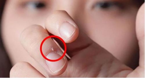 警惕! 男子手指长满癌细胞 竟是因为人人都爱做的小动作!