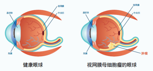 妈妈崩溃! 3个孩子竟患上同种眼癌! 这件事千万警惕 快看看孩子眼睛