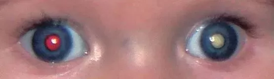 妈妈崩溃! 3个孩子竟患上同种眼癌! 这件事千万警惕 快看看孩子眼睛