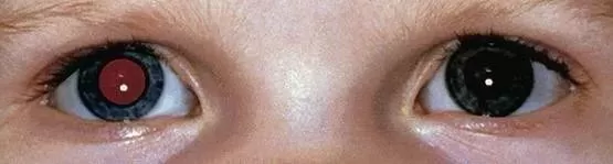 妈妈崩溃! 3个孩子竟患上同种眼癌! 这件事千万警惕 快看看孩子眼睛