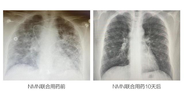 美权威医生用NMN治愈55岁新冠重症：免疫水平一晚提升85%、10天后转阴