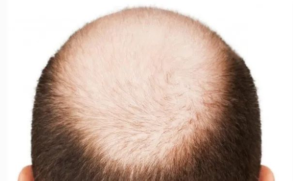 悲伤! 秃头男性感染新冠风险高40% 一医院男性患者几乎都是秃顶!