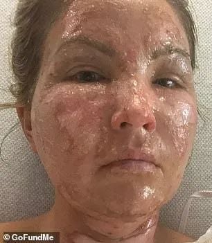 恐怖! 3娃美妈搓洗手液防新冠 遭火焰吞噬全身 惨毁容 全家被烧!