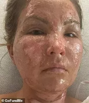 恐怖! 3娃美妈搓洗手液防新冠 遭火焰吞噬全身 惨毁容 全家被烧!