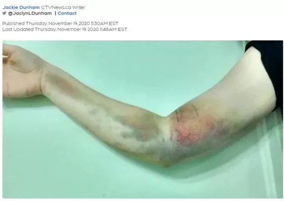 警惕! 加拿大17岁女孩献一次血 整条胳膊从此废了 一辈子变残疾人!