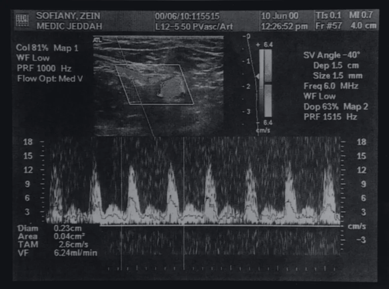 术后，受者子宫动脉多普勒超声图像 图源：参考文献 4