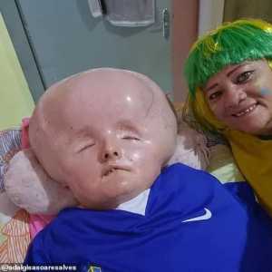 奇迹! 女子罕见疾病 头肿3倍大 神似外星人母亲悉心照顾活过30岁