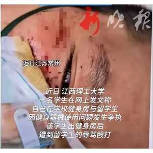 震怒！中国学生遭留学生围殴！脸部出血差点毁容！多方回应