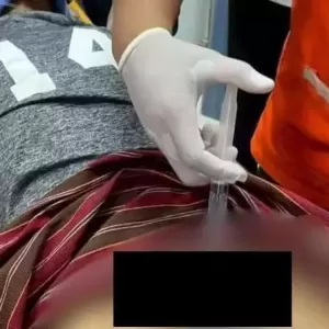 男子DD太大怕被偷 套双层钢圈 结果出不来了