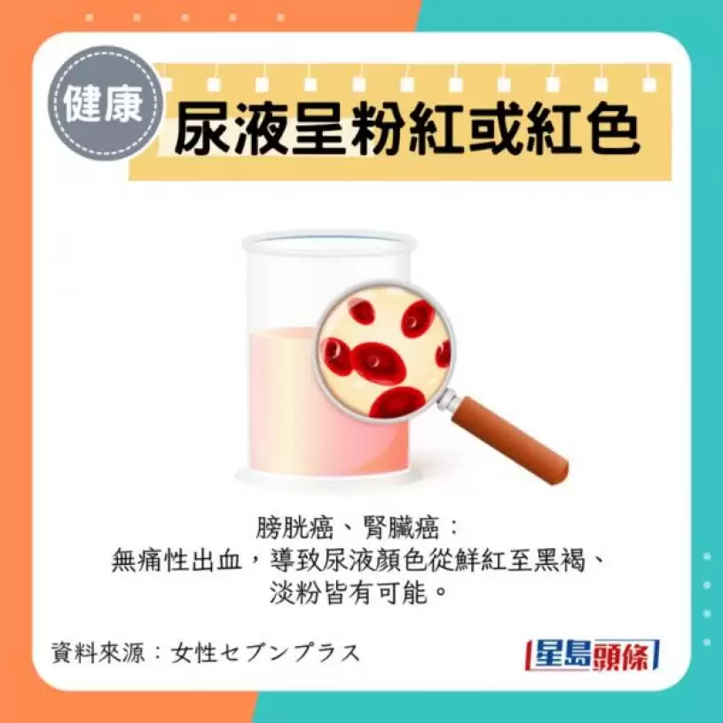 危疾先兆｜盘点13个身体夺命警号 这部位水肿恐患心脏病/肾病 夜间剧烈腹痛代表甚么？