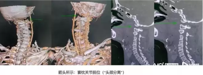 不可能的任务！6旬男“头颈分离”一度命危 医1招奇迹保命