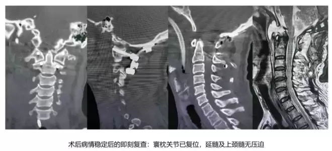 不可能的任务！6旬男“头颈分离”一度命危 医1招奇迹保命