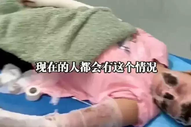 睡觉时手机放枕边充电突爆炸！女子惨毁容 全身7成烧烫伤