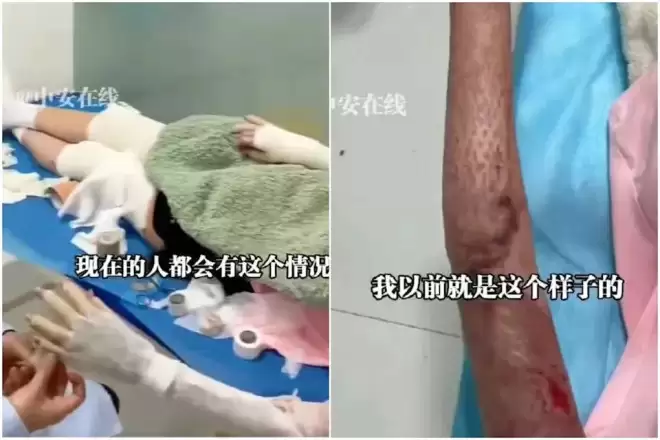 睡觉时手机放枕边充电突爆炸！女子惨毁容 全身7成烧烫伤