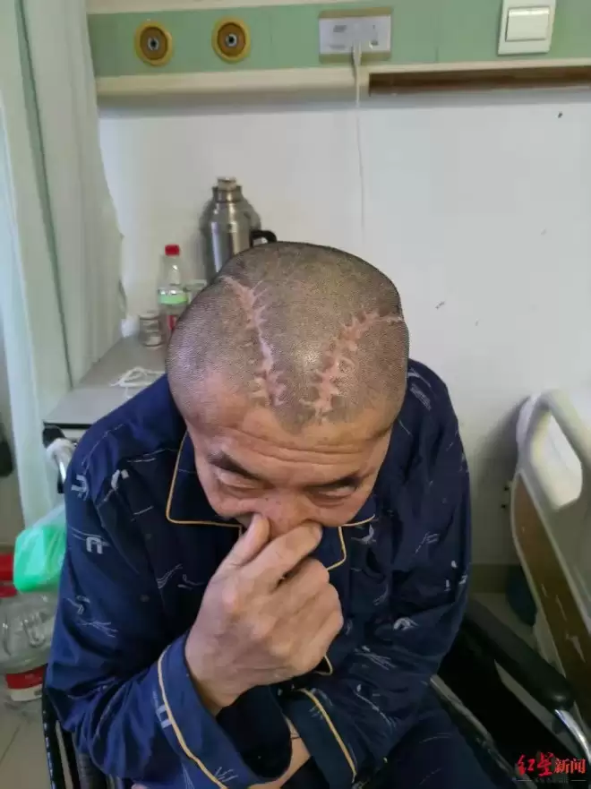 家属称男子三年前右脑出血被开左脑,医生发现出错又开右脑