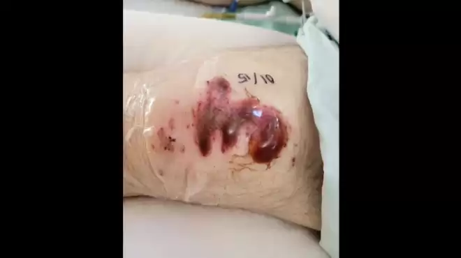 加拿大27岁男子戴耳机过马路, 被公交车撞残! 父亲表扬司机!