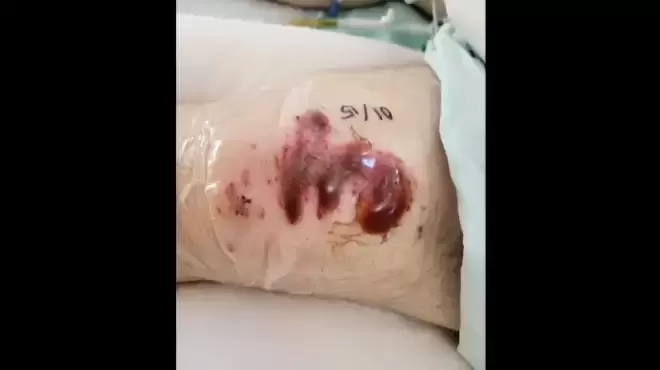 加拿大27岁男子戴耳机过马路, 被公交车撞残! 父亲表扬司机!