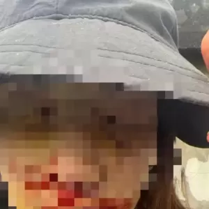 金晨就交通事故致歉，晒出受伤照片.....