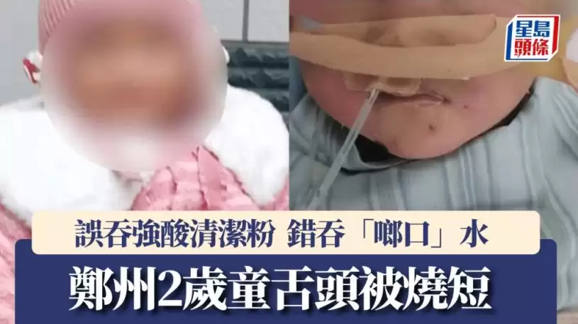 河南2岁童吞清洁粉灌水抢救  舌头惨烧短食道最窄剩1mm