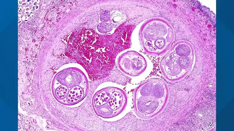 专家示警 广东食脑虫首现美西  食用蜗牛、虾蟹可能感染