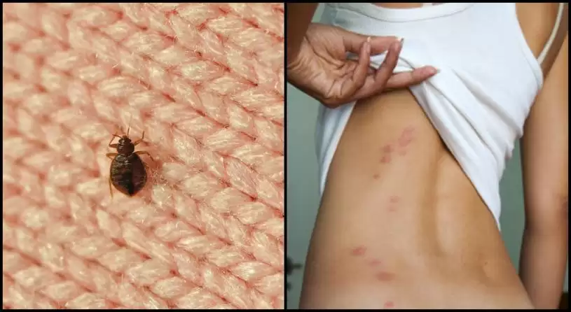 【世界睡眠日】满地可床虱之祸   受困扰的贫穷与富裕家庭比例为9比1