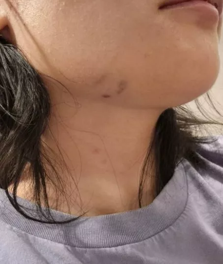 27岁中国女澳洲遭辱骂狂殴 满面鲜血 需辞职休养