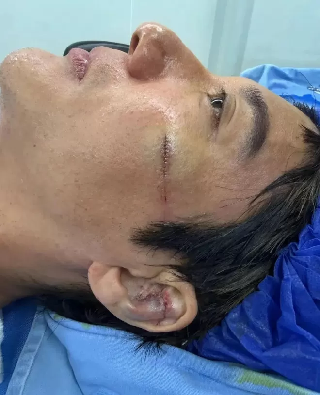 王力宏治疗摔伤细节曝光,去的医美科找的顶级专家
