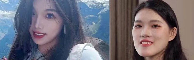 惨变“鞋拔子”…武汉24岁女正颌手术被做反 涉事医遭停职