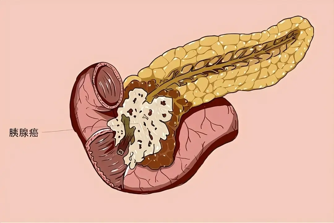 一人一针！黑色素瘤、胰腺癌、肺癌均突围，2026癌症疫苗全面开花