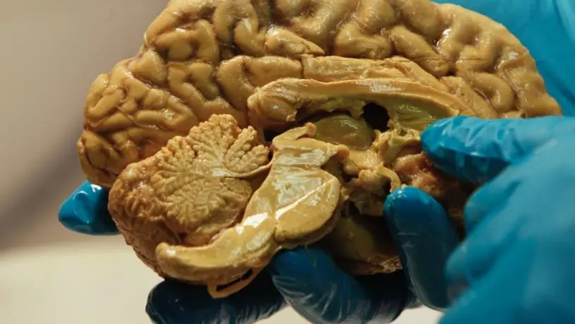 人类大脑竟是“两个器官”  惊人研究或有助渐冻人症治疗