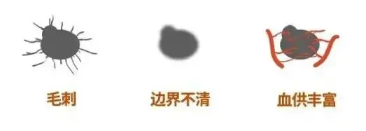 钟南山团队：73%肺癌病例来自“非高危人群”