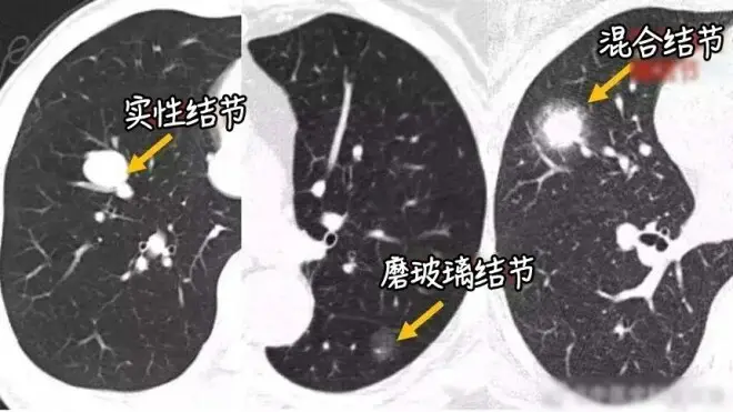 钟南山团队：73%肺癌病例来自“非高危人群”