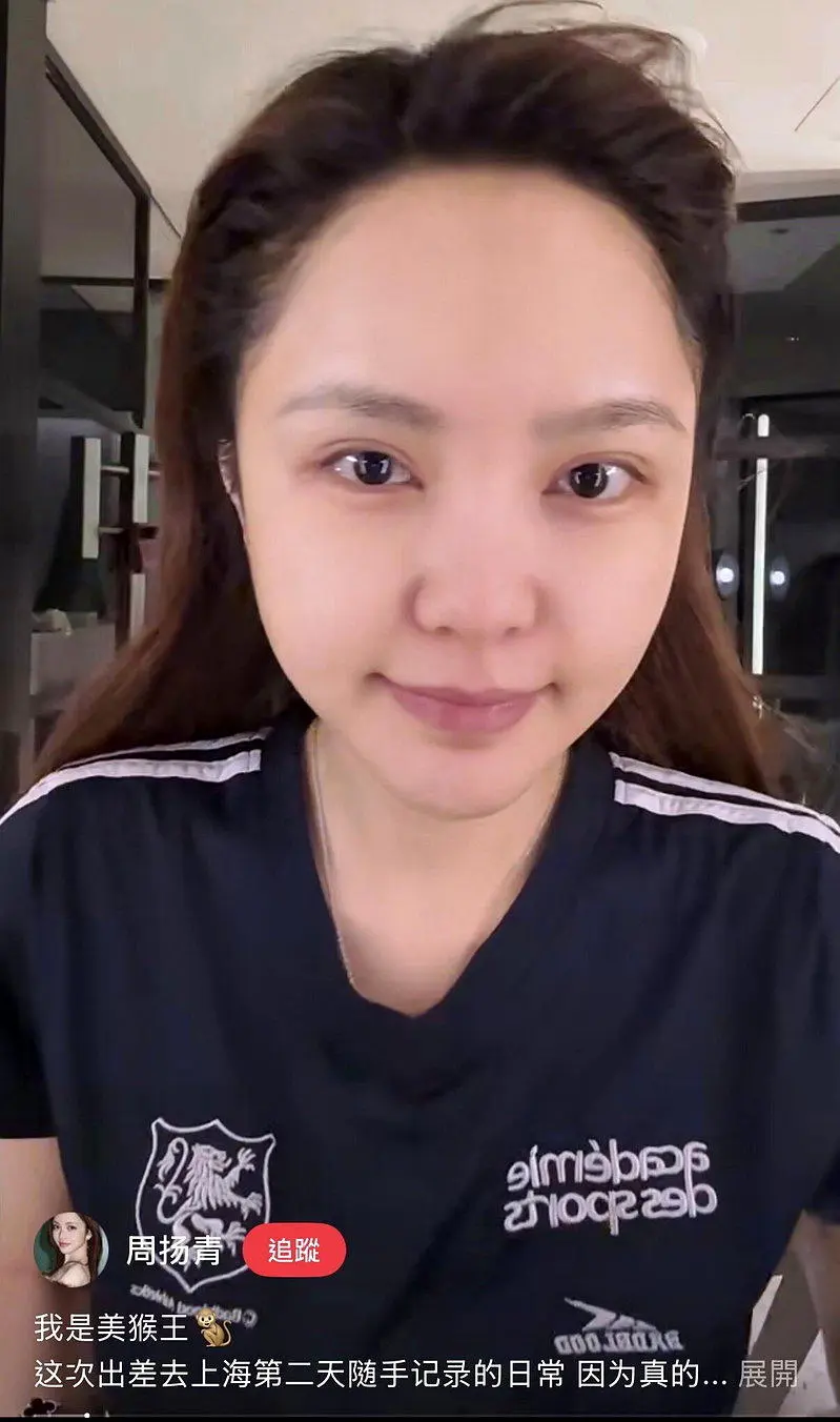 周扬青爆“医美后遗症大爆发” 亲口认了脸部馒化