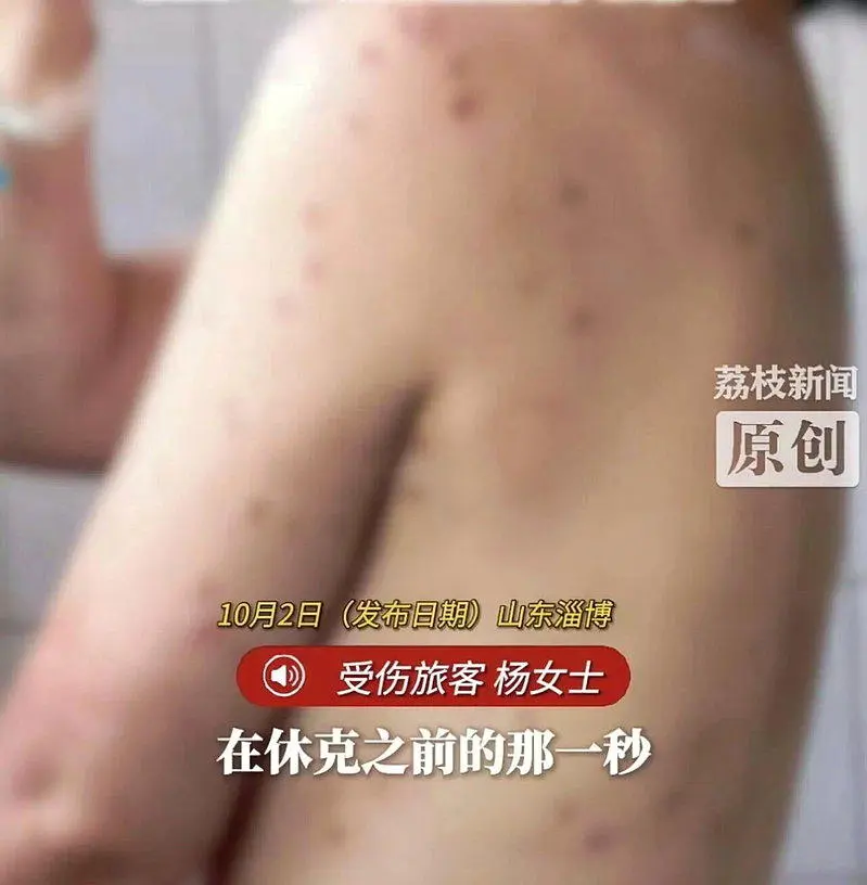 山东女玩高空钢索被蜂螫180针 “以为要死了”